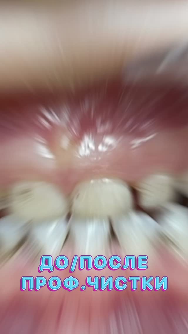 Профессиональная чистка зубов