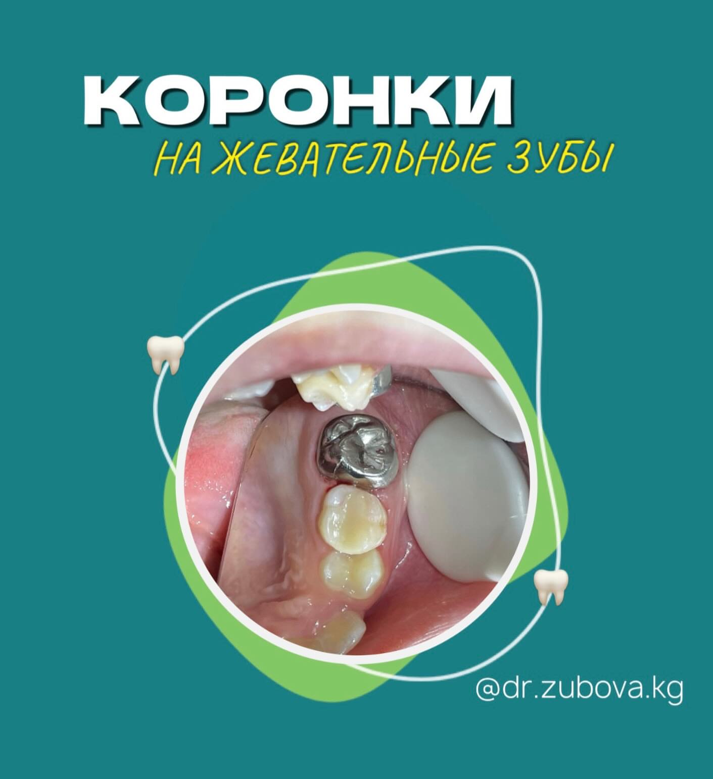 Протезирование молочных зубов