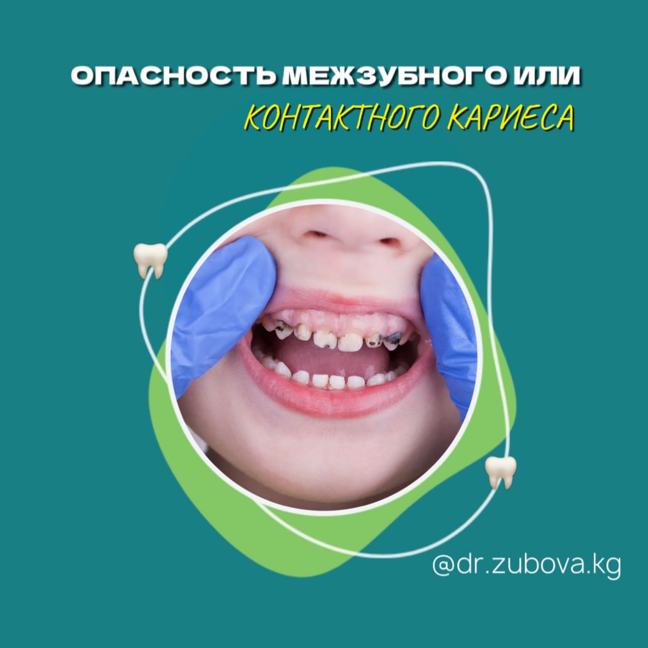 Лечение кариеса у детей